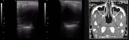 Uzi orrmelléküregek (Előadás diagnostere)