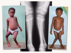 Valgus görbülete a lábát egy gyerek okoz és kezelés