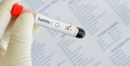 HIV Szifilisz tapasztalt tünetek nemi betegségek Moszkva