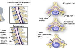 Féle masszírozó, hasznos osteochondrosis