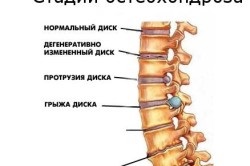 Féle masszírozó, hasznos osteochondrosis