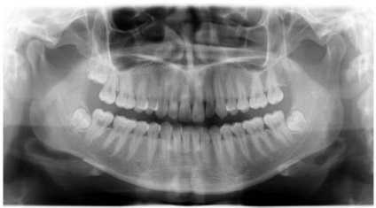 Bizonyos esetekben egy panoráma kép a fogak