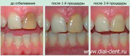 Belső fogfehérítés - lehetőségei és korlátai