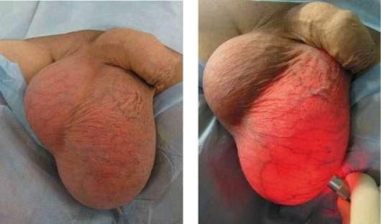 Hydrocele - tünetek, okok, diagnózis, kezelés hydrocephalus lyaichka, megelőzés és (tünetek) Hydrocele - tünetek, okok, diagnózis, kezelési módszerek vízkór lyaichka, megelőzésére és