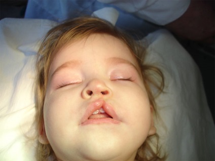 Chiloplasty gyerekek (műanyag ajak) - Kezelés, fotók, árak, foglalás (kezelés) Chiloplasty gyerekek (műanyag ajak) - Kezelés, fotók, árak, foglalás