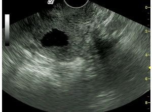 Folyadékok az Detection méh során ultrahangos diagnózis (diagnózis) Folyadékok az Detection méh során ultrahangos diagnosztikában