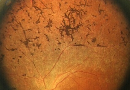 Abiotrophies retina okai és a kezelés