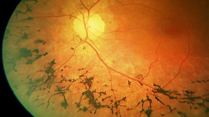 abiotrophies tapetoretinalnoy retina, pigment kezelés