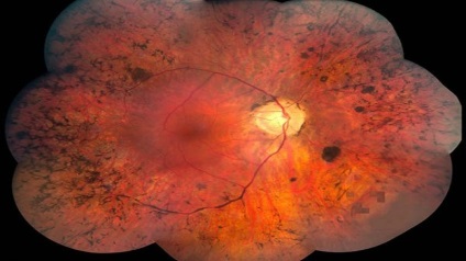abiotrophies tapetoretinalnoy retina, pigment kezelés