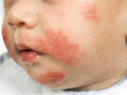 Allergia a csecsemő - mi a teendő (allergia csecsemők) Allergia a csecsemő - mit kell tenni