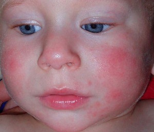 Allergia a csecsemő tünetek és kezelés