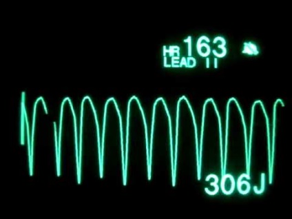 Arrhythmia szívroham tünetei és jelei (jelek) Szívritmuszavar tünetei támadás