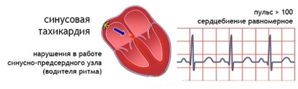 Arrhythmia szívroham tünetei és jelei (jelek) Szívritmuszavar tünetei támadás
