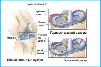 Fájdalom a csontok az alsó lábszár elülső, a hátsó - okok, elsősegély