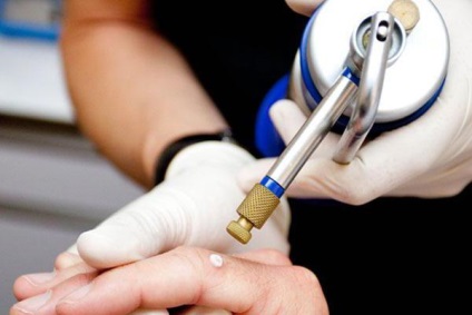 Szemölcsös nevus a fejbőr (rész) Szemölcsös anyajegyet a fejbőr