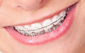 Damon egyértelmű fogszabályozó rendszer a nyomvonal a fogazat