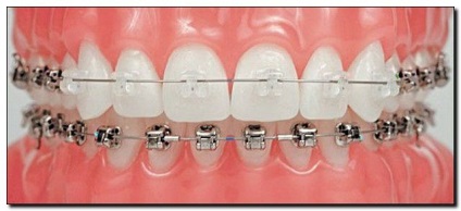 Damon egyértelmű fogszabályozó rendszer a nyomvonal a fogazat