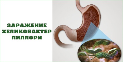 Mi a teendő súlyosbodásához gastritis (sósav készítmény) Mi a teendő során súlyosbodása gyomorhurut