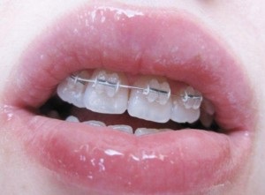 Mi okozza a fogszuvasodást lehet a legjobb hely a fogászatban