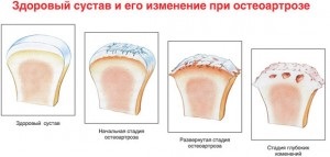 Deformáló osteoarthritis a csípő etiológiájú klinikai jellemzői, kezelés (osteoarthritis) Deformáló osteoarthritis a csípő etiológiájú klinikai jellemzők, a kezelés
