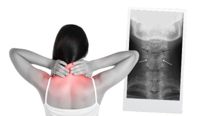 Degeneratív Dystrophiás változások a nyaki gerinc