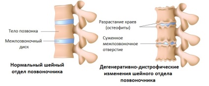 Degeneratív Dystrophiás változások a nyaki gerinc (nyak) Degeneratív Dystrophiás változások a nyaki gerinc