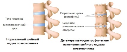 Degeneratív Dystrophiás változások a nyaki gerinc