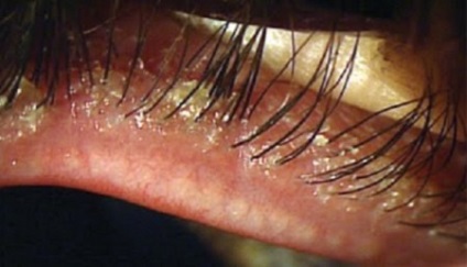 Demodectic blepharitis okoz, tünetek és a kezelés