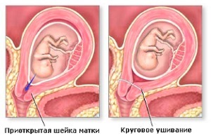A diagnózis és a kezelés a nyaki értés terhesség alatt