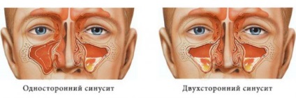 Kétoldalas arcüreggyulladás tünetei és kezelése, megelőző intézkedések