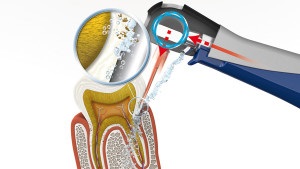Hatékony periodontális betegség kezelésében (periodontitis) Hatékony kezelés periodontitis