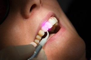 Hatékony a periodontális betegség kezelésére (egy foggal álló) Hatékony kezelés periodontitis