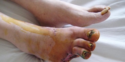 Üszkösödés fotó láb, a kezdeti szakaszban a diabetes mellitus 1-es típusú és 2