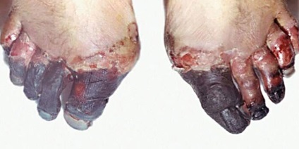 Cukorbeteg láb – rettegett szövődmények