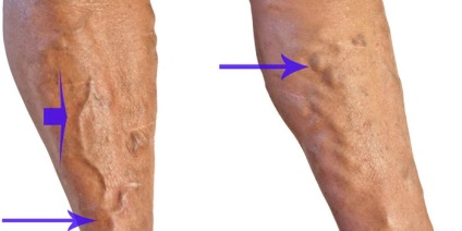 A lábfej gangrénájának kezelése cukorbetegségben