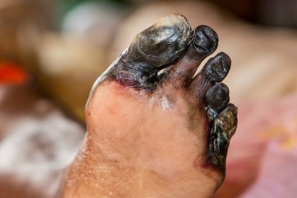 üszkösödés a lábát a cukorbetegség kezelésére photo