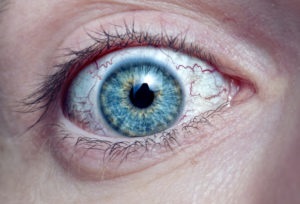 Herpesz a szemet - ophthalmoherpes tünetei, kezelése, fotók