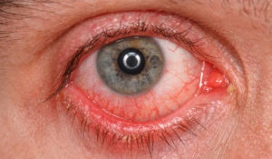Herpesz a szemet - ophthalmoherpes tünetei, kezelése, fotók