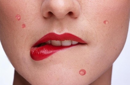 Herpes hátoldalán a tünetek és a kezelés (kezelés) Herpes hátán tünetei és kezelése