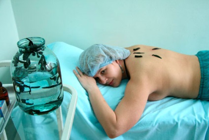 Hirudotherapy előnyök és árt az emberi (girudoterapiya előnyei és hátrányai) Hirudotherapy előnyök és káros az emberi