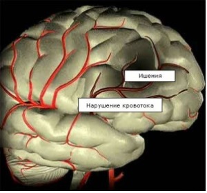 agyi ischaemia az újszülöttben okok, kezelés, következményei