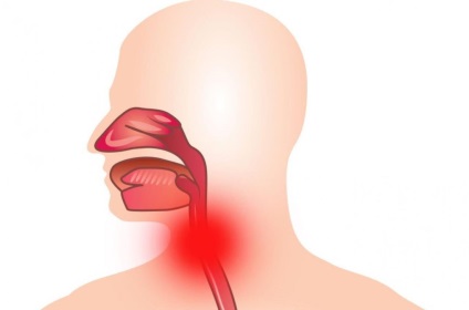 Hogyan lehet megkülönböztetni az angina származó SARS influenza és torokfájás a gyermek