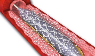 Hogyan lehet megelőzni a restenosis a stent