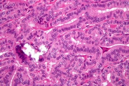 Pajzsmirigy carcinoma korai tünetei változatai a tanfolyam és a prognózis a beteg