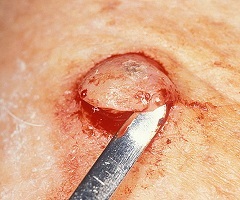 keratoactanthoma bőr - besorolás, okai, kezelése