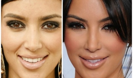 Kim Kardashian előtt és után plasztikai sebészet fotók és videó