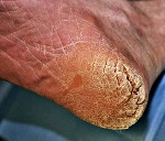 Klimaxos keratoderma - okai, tünetei, diagnózis és kezelés (keratoderma) Klimaxos eiszarusodás - okai, tünetei, diagnózisa és kezelése