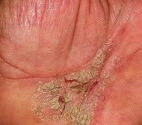 Klimaxos keratoderma - okai, tünetei, diagnózis és kezelés (keratoderma) Klimaxos eiszarusodás - okai, tünetei, diagnózisa és kezelése