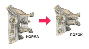Konkrestsentsiya nyakcsigolya (konkrestsentsiya) Konkrestsentsiya nyakcsigolya