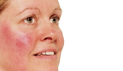 Rosacea kezelés népi jogorvoslati otthon